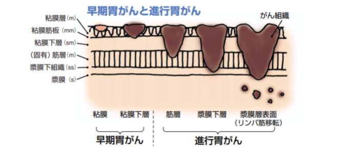 早期がんイメージ