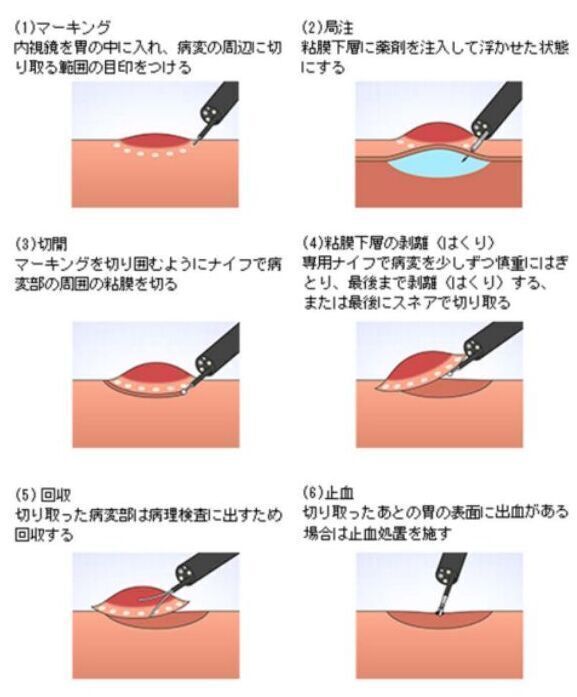 ESDの手順